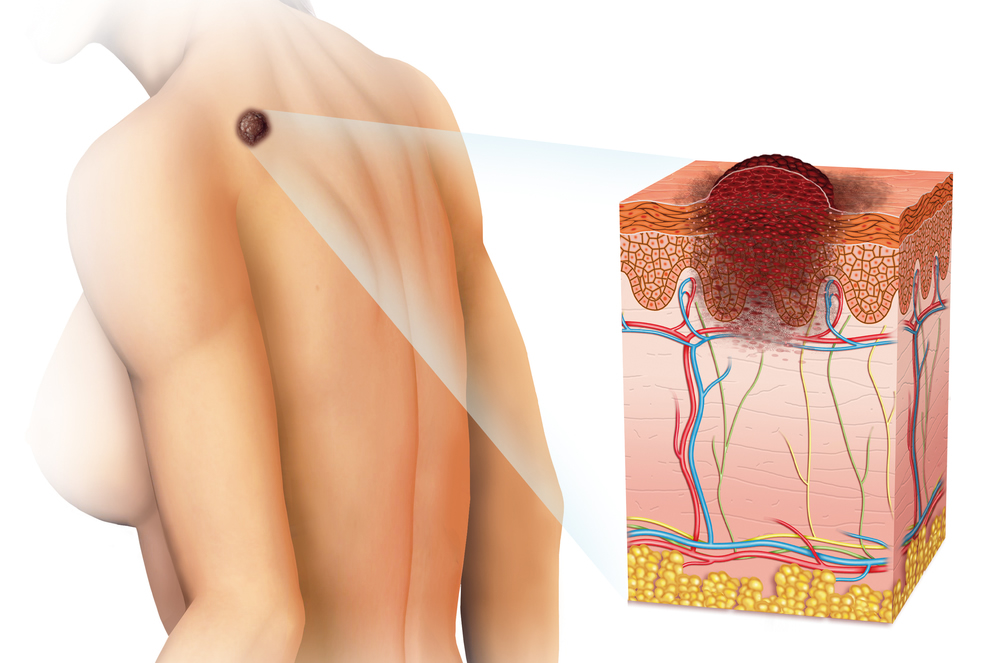 Malignant Melanoma Tumors