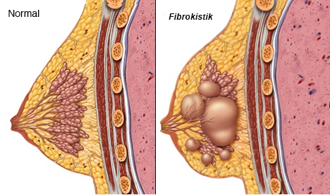 WHAT TO DO WHEN A MASS IS DETECTED IN THE BREAST
