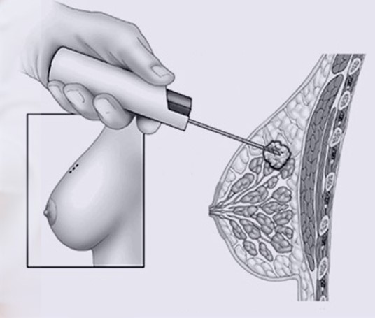 WHAT IS TISSUE DIAGNOSIS (BIOPSY) AND WHO SHOULD IT BE DONE?
