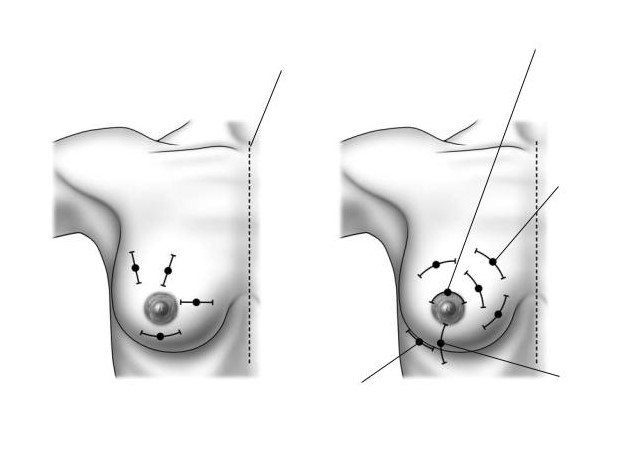 Breast Conserving Surgery Application in the Treatment of Breast Cancer
